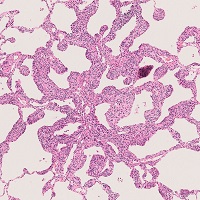 微小髄膜細胞様結節